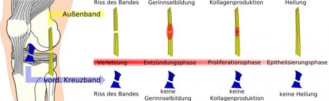 Kreuzbandriss